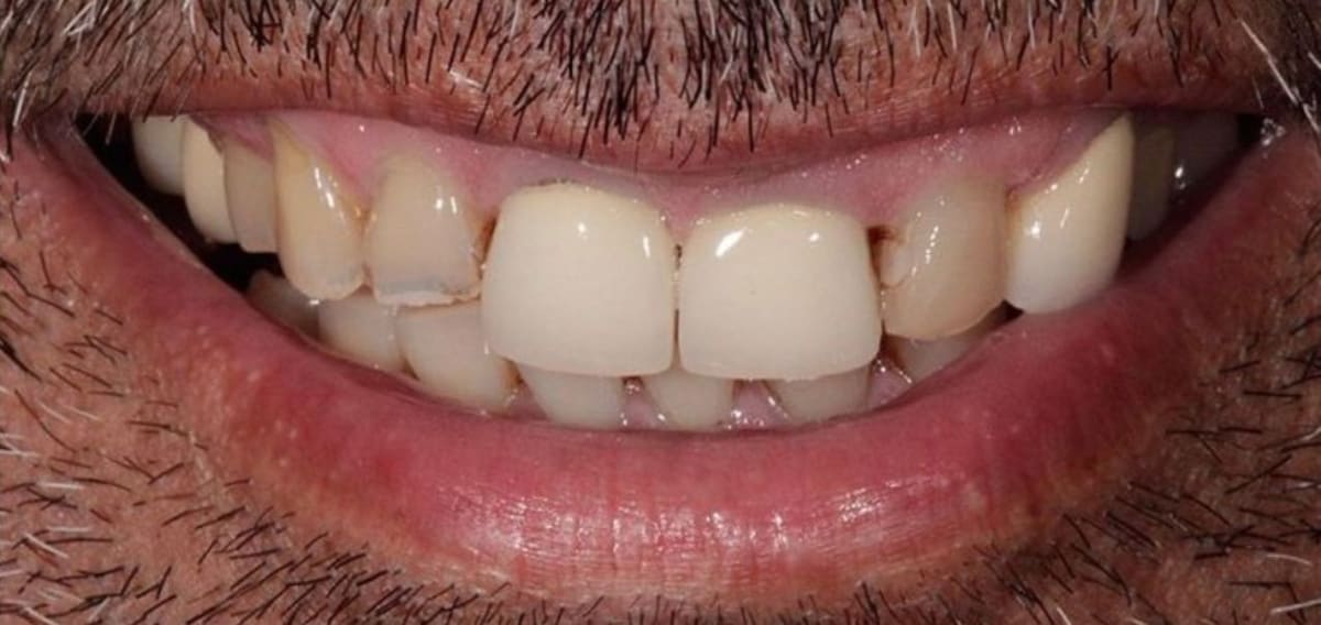 Cosmetic Smile & Whitening — Beauty Extras in Miami